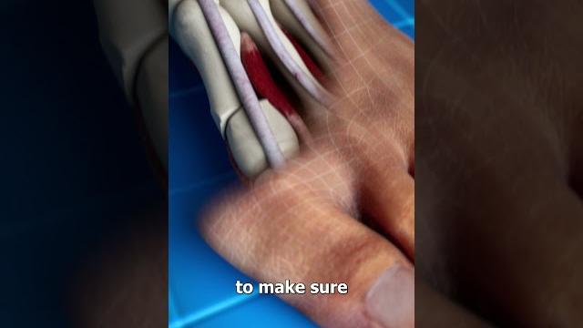 Bunion correction (explained) Bunion correction (explained)