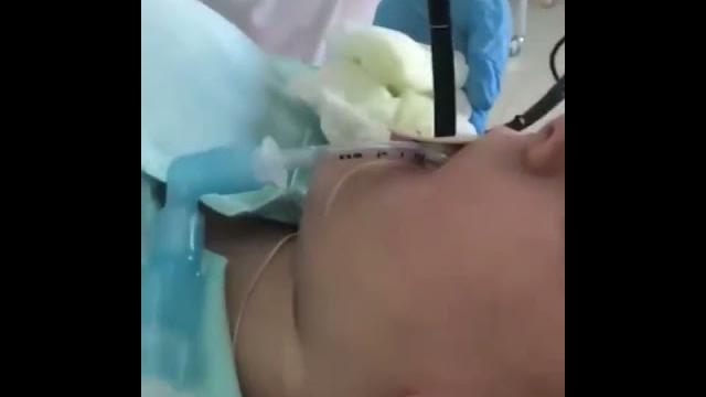 Snake removed from stomach | snake removed from a woman's gi tract | endoscopy #endoscopicremoval Snake removed from stomach | snake removed from a woman's gi tract | endoscopy #endoscopicremoval