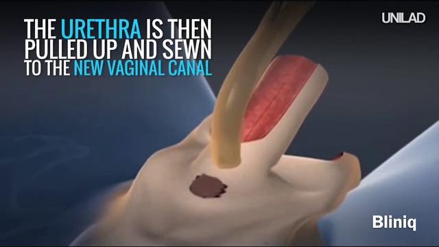 Sex reassignment surgery (male to female) at bliniq cosmetic surgery centre and medspa Sex reassignment surgery (male to female) at bliniq cosmetic surgery centre and medspa