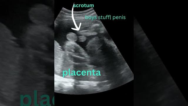 Ultrasound showing baby boy | gender reveal #shorts Ultrasound showing baby boy | gender reveal #shorts