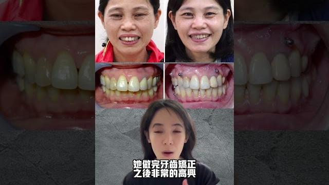 矯正諮詢被退貨,不是因為你太老,而是你太難做#矯正年齡 矯正諮詢被退貨,不是因為你太老,而是你太難做#矯正年齡