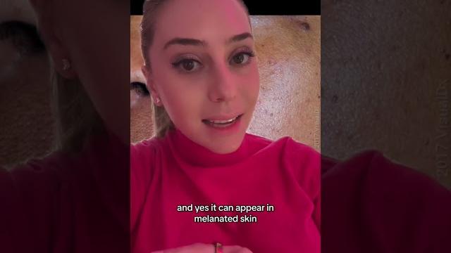 Rosacea vs. acne part 1 #shorts Rosacea vs. acne part 1 #shorts