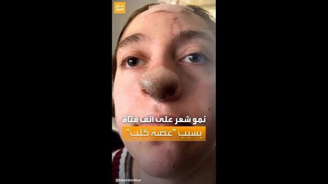 حديث السوشال | "عضة كلب" تتسبب في نمو شعر على أنف فتاة حديث السوشال | "عضة كلب" تتسبب في نمو شعر على أنف فتاة