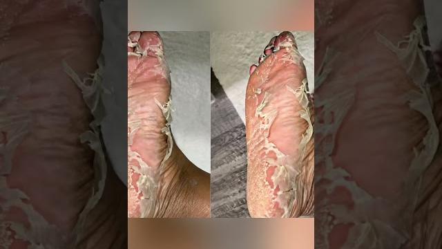 Foot peel mask #shorts #footpeel #footpeelmask #footmask Foot peel mask #shorts #footpeel #footpeelmask #footmask