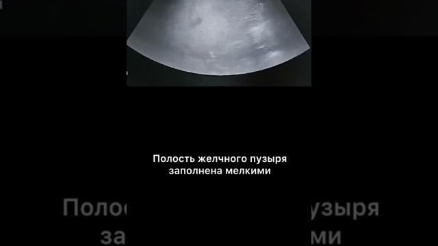 #узи #холецистит #узи #холецистит