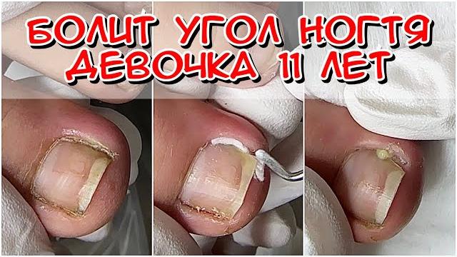 Болит угол ногтя у девочки 11 лет / вросший ноготь у ребенка / болит палец у ребенка что делать / Болит угол ногтя у девочки 11 лет / вросший ноготь у ребенка / болит палец у ребенка что делать /