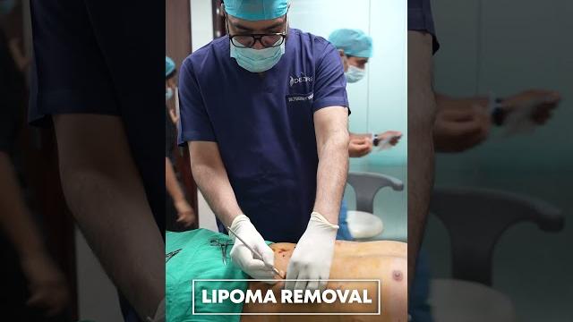 Lipoma cure | multiple lipoma removal #shorts Lipoma cure | multiple lipoma removal #shorts