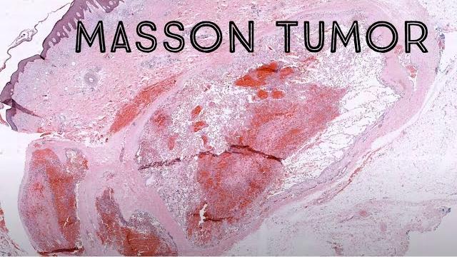 Masson "tumor” (intravascular papillary endothelial hyperplasia ipeh) pattern of organizing thrombus Masson "tumor” (intravascular papillary endothelial hyperplasia ipeh) pattern of organizing thrombus