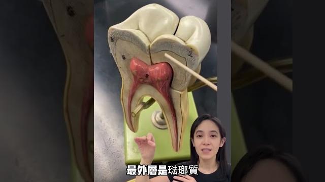補蛀牙變抽神經?為什麼牙醫要挖那麼大洞#蛀牙 補蛀牙變抽神經?為什麼牙醫要挖那麼大洞#蛀牙
