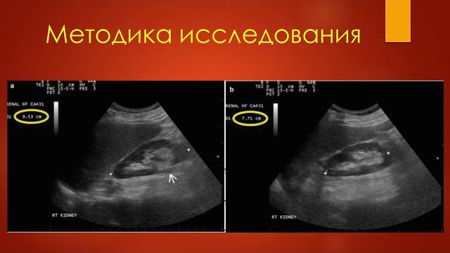 Узи почек. станислав феданов. Узи почек. станислав феданов.