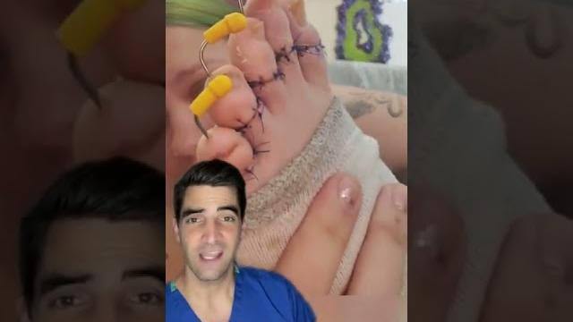 Fix toe fractures with pins Fix toe fractures with pins