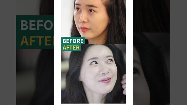 Bj바카스님의 절개모발이식 1년 경과 before&after Bj바카스님의 절개모발이식 1년 경과 before&after