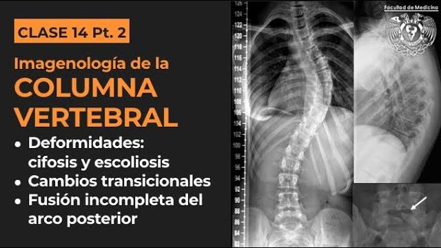 14.2 - imagenología de columna: deformidades (cifosis y escoliosis) y cambios transicionales 14.2 - imagenología de columna: deformidades (cifosis y escoliosis) y cambios transicionales