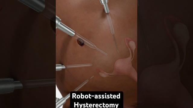 Removing the uterus (3d animation) Removing the uterus (3d animation)