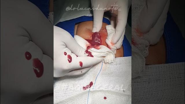 Drenagem de abscesso! Drenagem de abscesso!