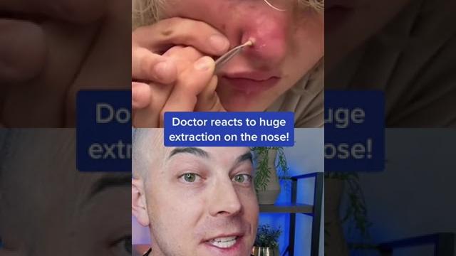 Doctor reacts to massive nose pimple extraction! #nosepimple #pimplepopper #dermreacts Doctor reacts to massive nose pimple extraction! #nosepimple #pimplepopper #dermreacts