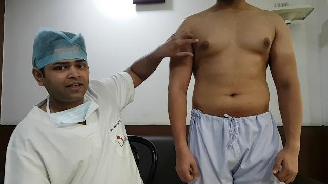 Gynecomastia grade 2 with puffy nipple Gynecomastia grade 2 with puffy nipple