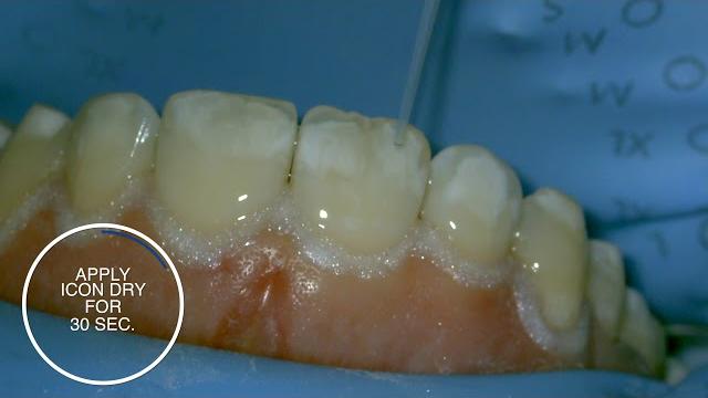 White spot treatment using infiltration with icon - step-by-step White spot treatment using infiltration with icon - step-by-step