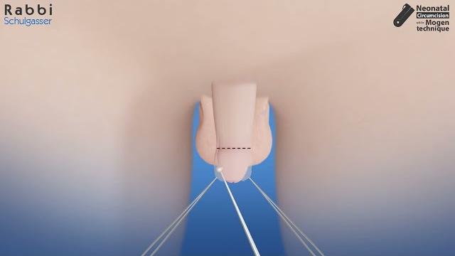 Circumcision using the mogen technique, animation Circumcision using the mogen technique, animation