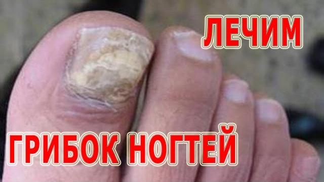 Как лечить грибок ногтей на руках и ногах. профилактика микоза. противогрибковые препараты. Как лечить грибок ногтей на руках и ногах. профилактика микоза. противогрибковые препараты.