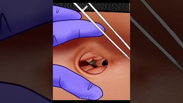 Asmr navel stone removal treatment #asmr #oddlysatisfying #shorts #relaxingasmr #asmrvideos #viral Asmr navel stone removal treatment #asmr #oddlysatisfying #shorts #relaxingasmr #asmrvideos #viral
