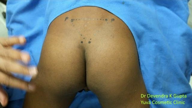 Caudal sacral block Caudal sacral block