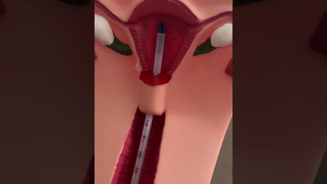 Iud insertion Iud insertion