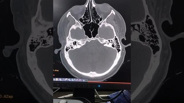 Ct scan of pns.#viral #shortfeeds #medical . Ct scan of pns.#viral #shortfeeds #medical .