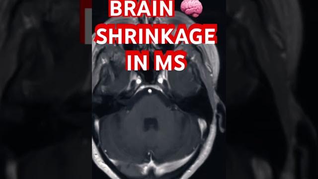 Brain shrinkage & black holes in multiple sclerosis Brain shrinkage & black holes in multiple sclerosis