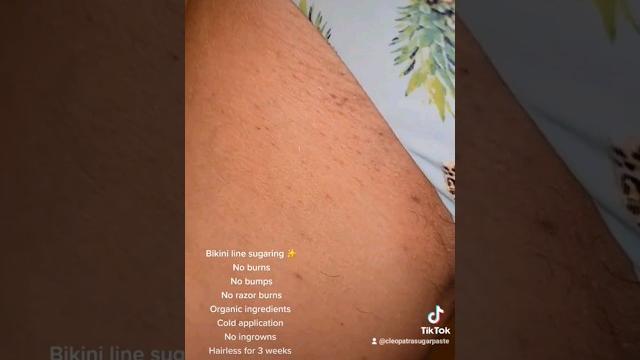 Bikini line "wax" without razor burns,irritations, bumps,ingrowns! #sugaring #sugarwax #hairremoval Bikini line "wax" without razor burns,irritations, bumps,ingrowns! #sugaring #sugarwax #hairremoval