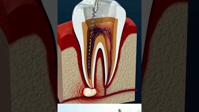 Root canal treatment & tooth abscess Root canal treatment & tooth abscess