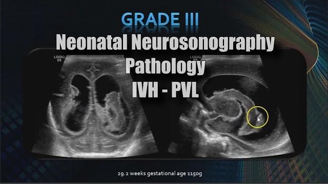Neonatal neurosonography | pathology | ivh - pvl Neonatal neurosonography | pathology | ivh - pvl