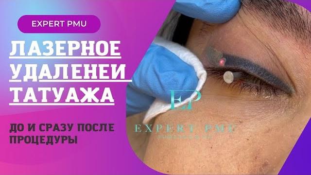 Удаление татуажа век лазером: до и сразу после процедуры Удаление татуажа век лазером: до и сразу после процедуры