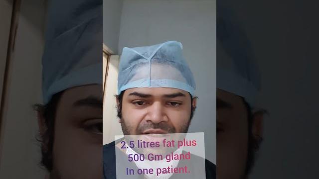 So much fat in gynecomastia surgery So much fat in gynecomastia surgery
