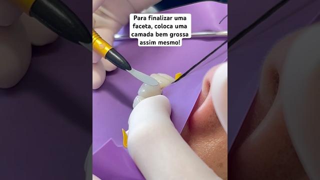 Passo a passo da última camada de resina composta #facetas #dentista #odontologia #odontologo Passo a passo da última camada de resina composta #facetas #dentista #odontologia #odontologo