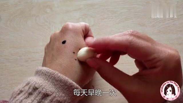 长瘊子影响美观,只需一根绳子,轻松结痂无副作用 长瘊子影响美观,只需一根绳子,轻松结痂无副作用