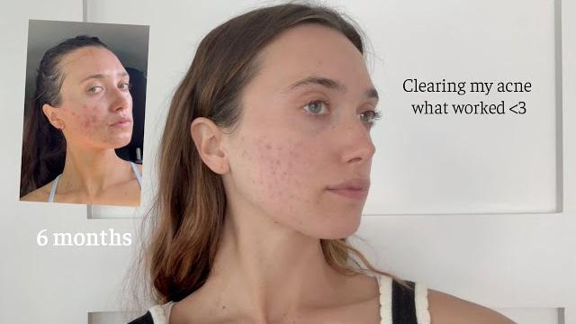 How i'm clearing my acne! what is working - health routine, microneedling, & feeling confident How i'm clearing my acne! what is working - health routine, microneedling, & feeling confident