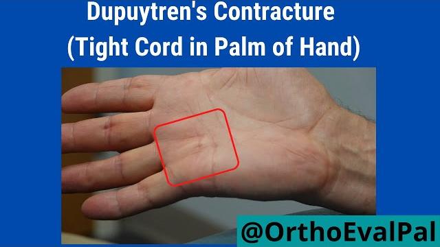 Dupuytren's contracture (tight cord in palm of hand) Dupuytren's contracture (tight cord in palm of hand)