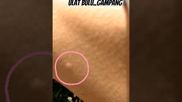 Tips saat kena ulat bulu di kebun #shorts Tips saat kena ulat bulu di kebun #shorts