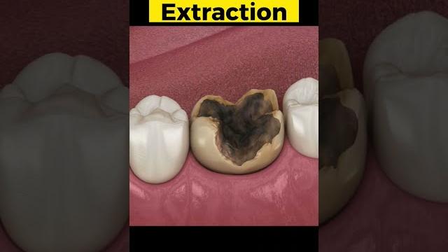 Tooth extraction 3d animation #toothextraction #toothdecay Tooth extraction 3d animation #toothextraction #toothdecay