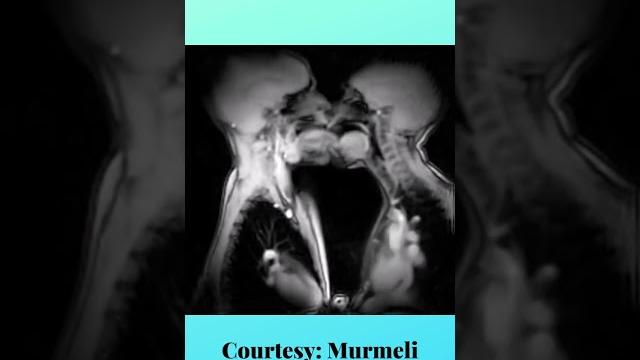 French kissing captured under mri French kissing captured under mri