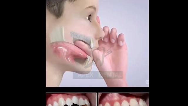 Baby thumbs sucking effect on teeth and jaws Baby thumbs sucking effect on teeth and jaws