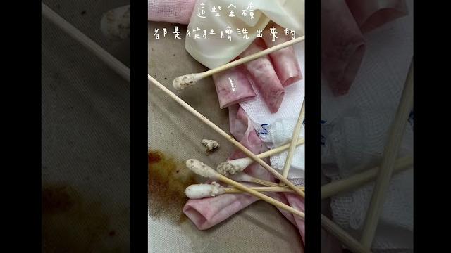洗肚臍 #醫療 #開刀房日常 #麻姊日常 #大家記的洗肚臍 #肚臍 #結石 洗肚臍 #醫療 #開刀房日常 #麻姊日常 #大家記的洗肚臍 #肚臍 #結石
