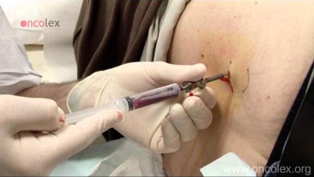 Bone marrow aspiration and biopsy from the iliac crest • oncolex Bone marrow aspiration and biopsy from the iliac crest • oncolex