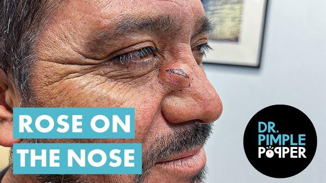 Dr pimple popper opens a rose on the nose Dr pimple popper opens a rose on the nose