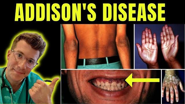 Doctor explains addison's disease (adrenal insufficiency): definition, symptoms, treatment & more. Doctor explains addison's disease (adrenal insufficiency): definition, symptoms, treatment & more.