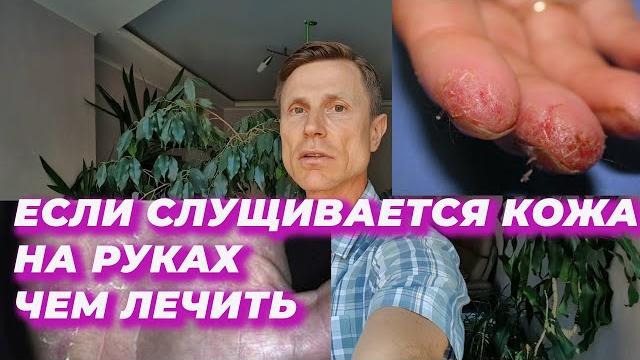 Если слущивается кожа на руках. чем лечить. Если слущивается кожа на руках. чем лечить.