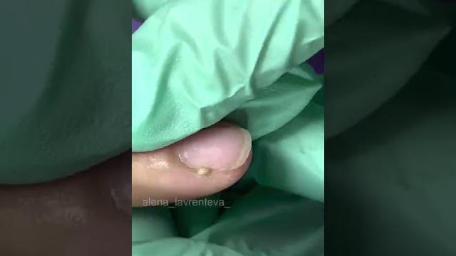 Оторвала заусенец / гной на пальце / загноился палец? / опух палец, что делать? #shorts Оторвала заусенец / гной на пальце / загноился палец? / опух палец, что делать? #shorts