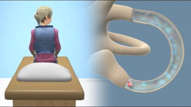 Epley maneuver to treat bppv vertigo Epley maneuver to treat bppv vertigo