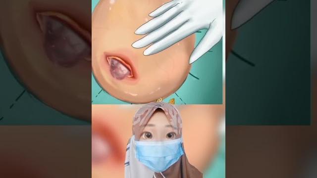 Kakinya bengkak karena tumor |mv #shorts Kakinya bengkak karena tumor |mv #shorts